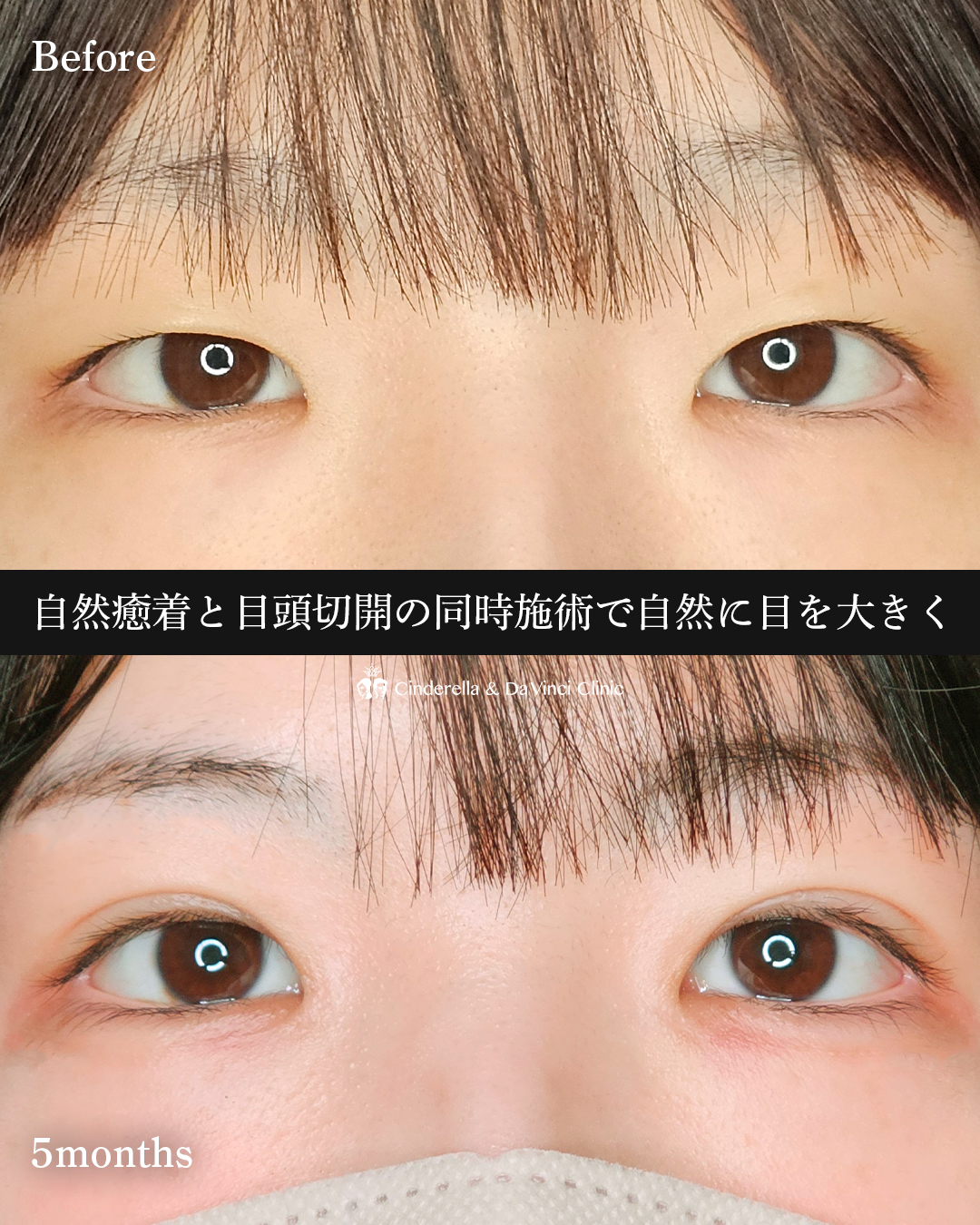 目を大きくするの画像