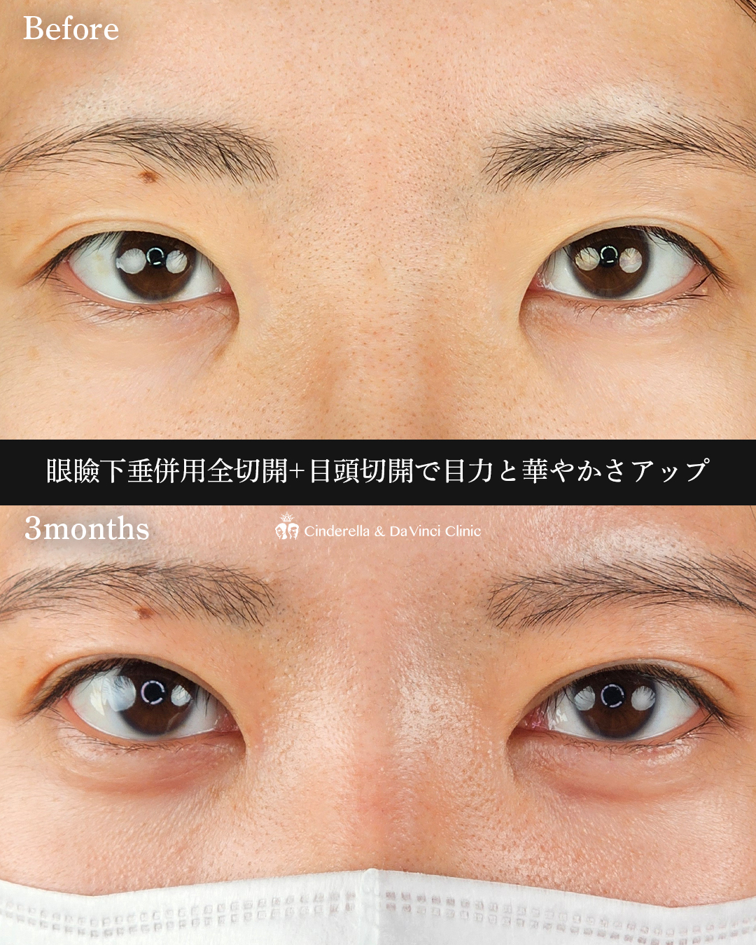 目をぱっちりさせるの画像