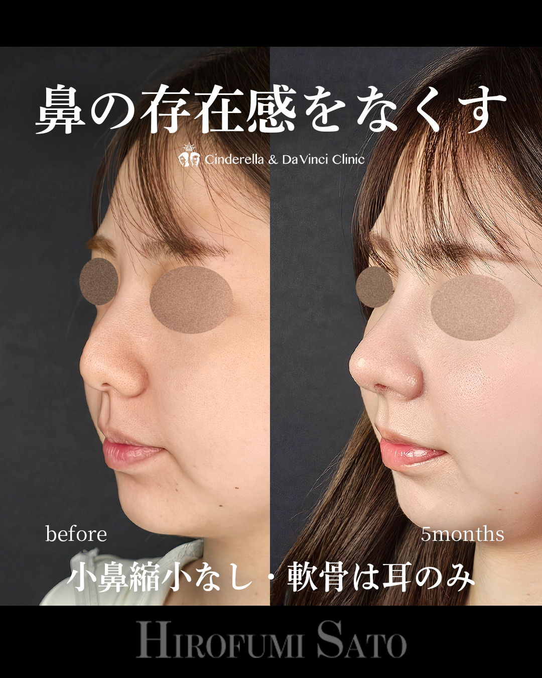 鼻の存在感をなくすの画像