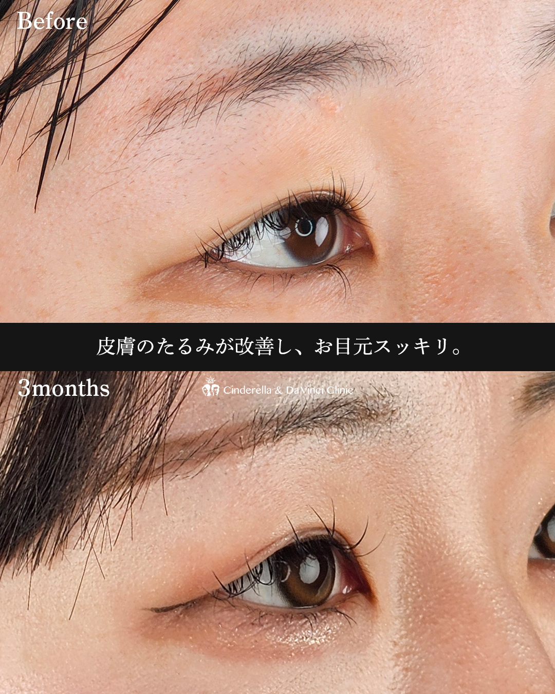 目と眉の距離近づけるの画像