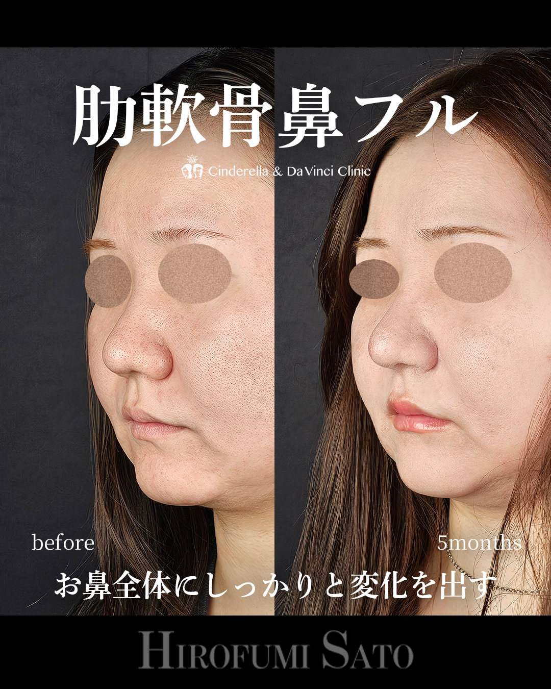 肋軟骨鼻フルの画像