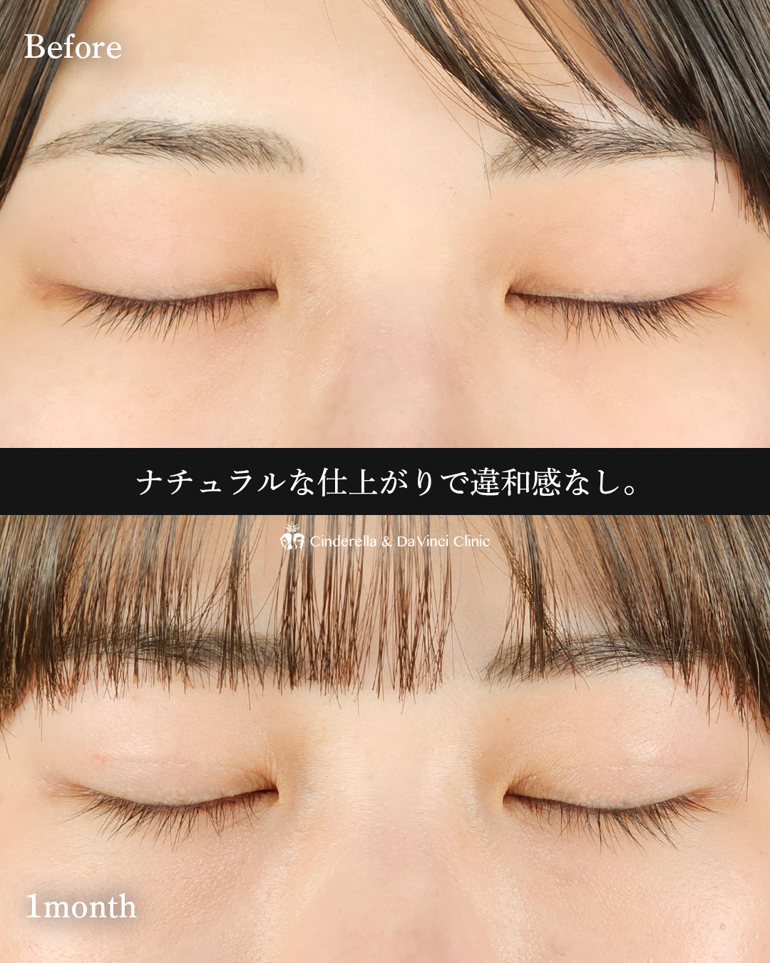 自然な二重の画像