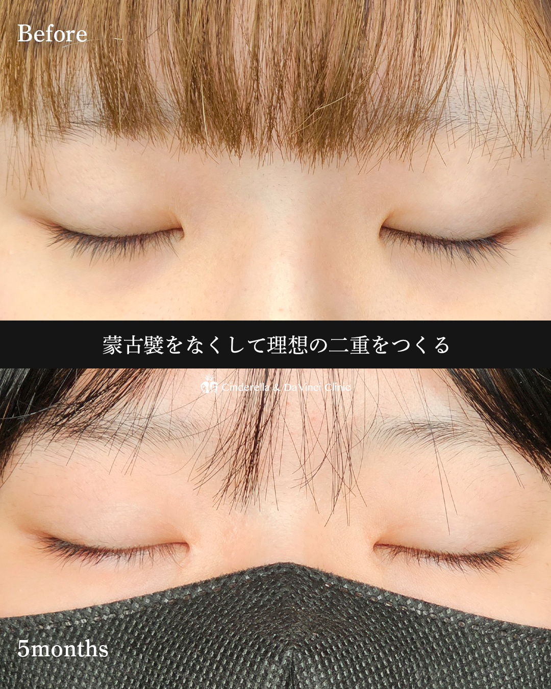 理想の二重にの画像