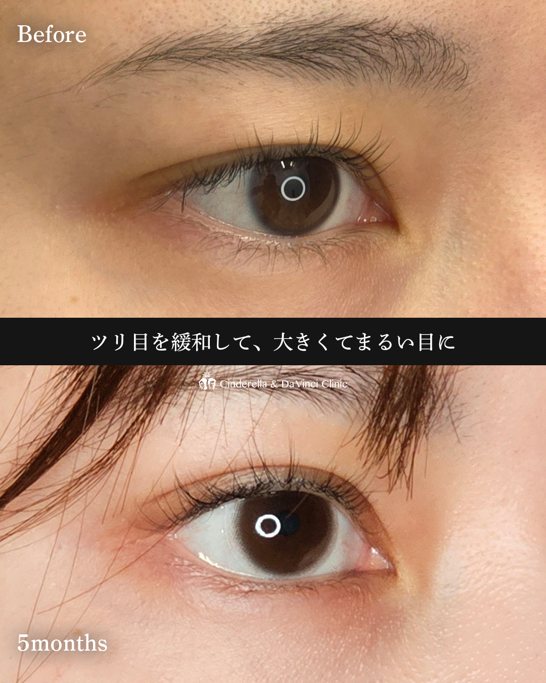 目を大きくするの画像