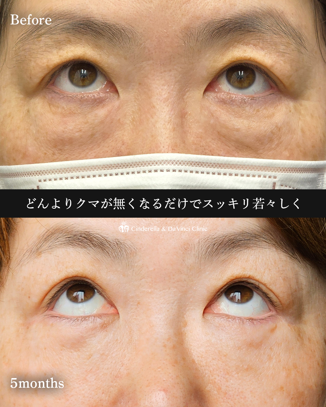 目の下のたるみ切除の画像