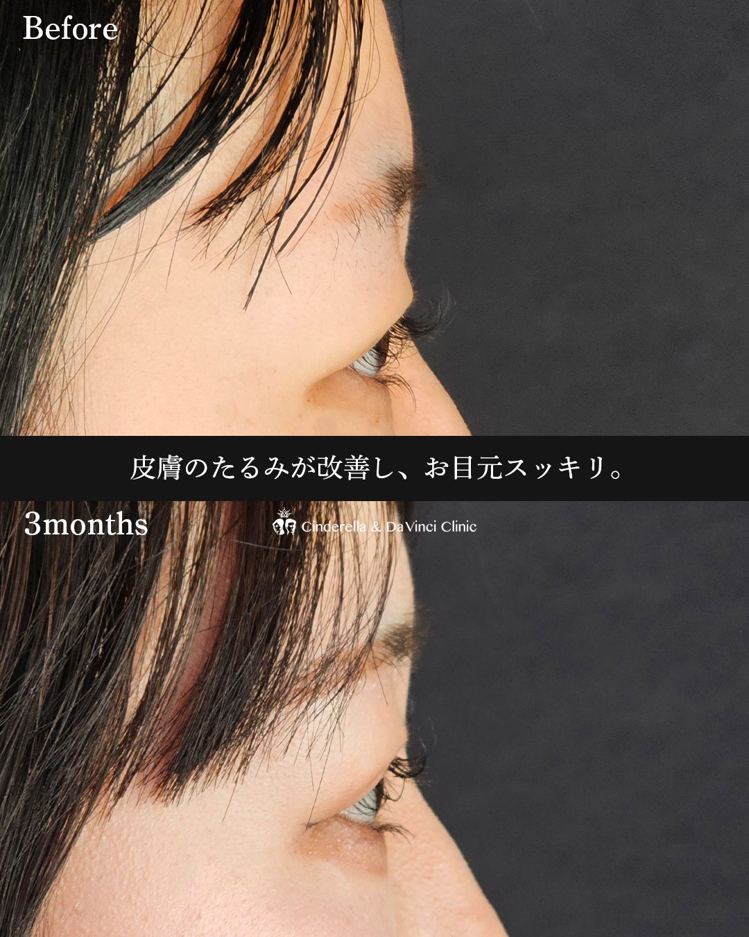 目と眉の距離近づけるの画像