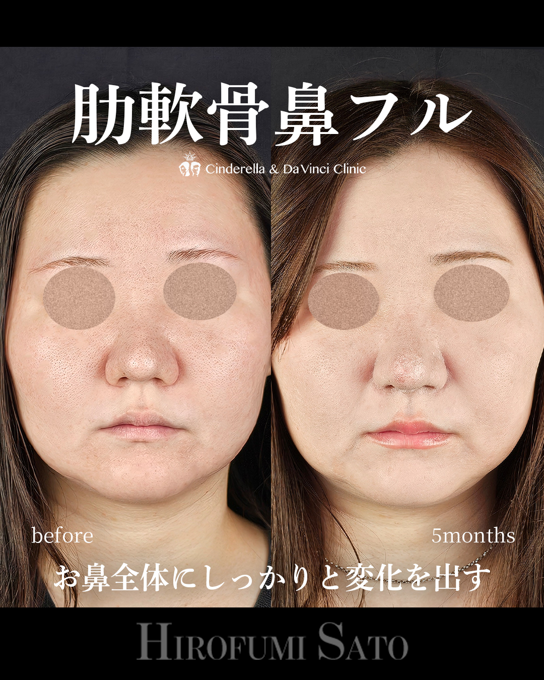 肋軟骨鼻フルの画像