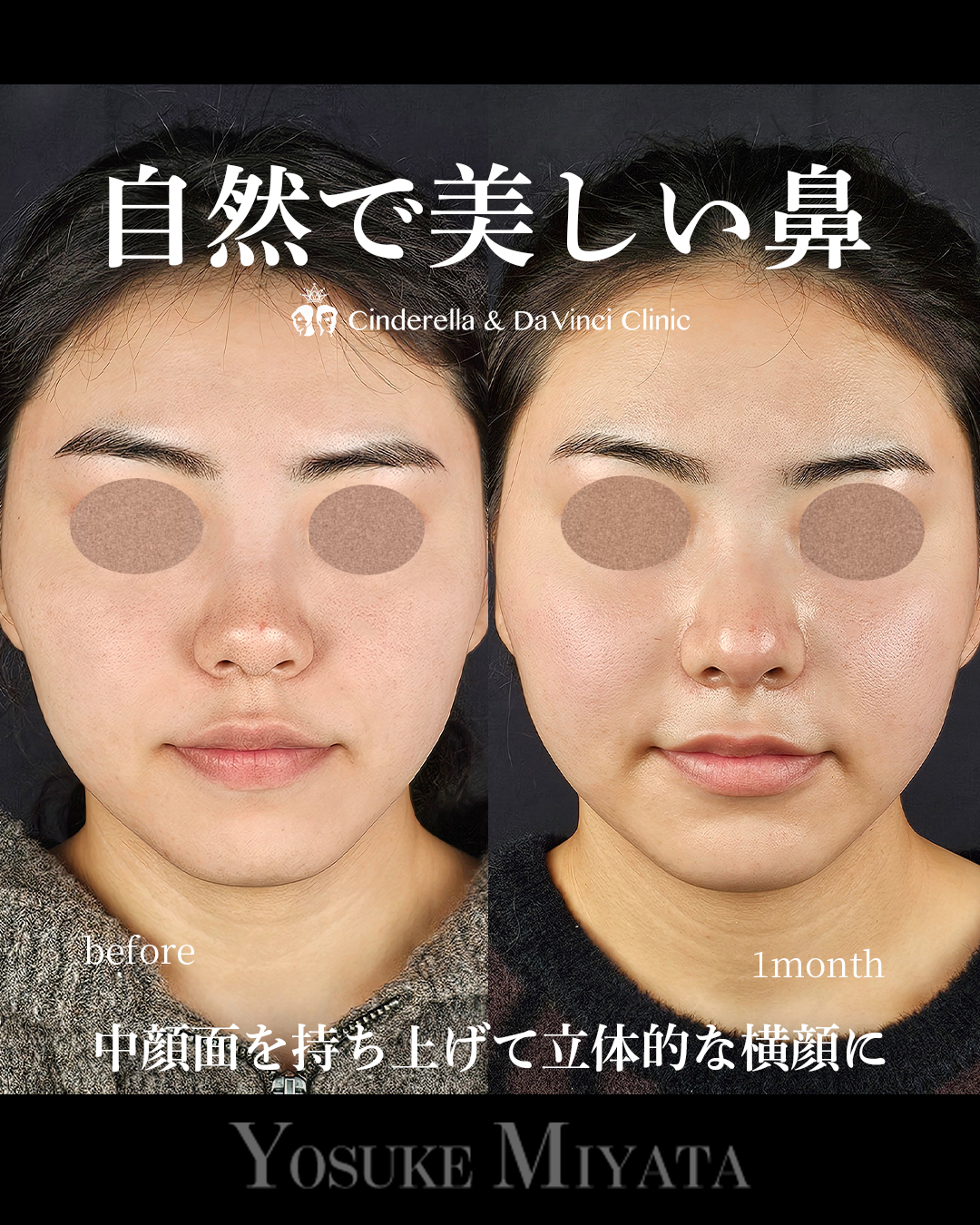 自然で美しい鼻の画像