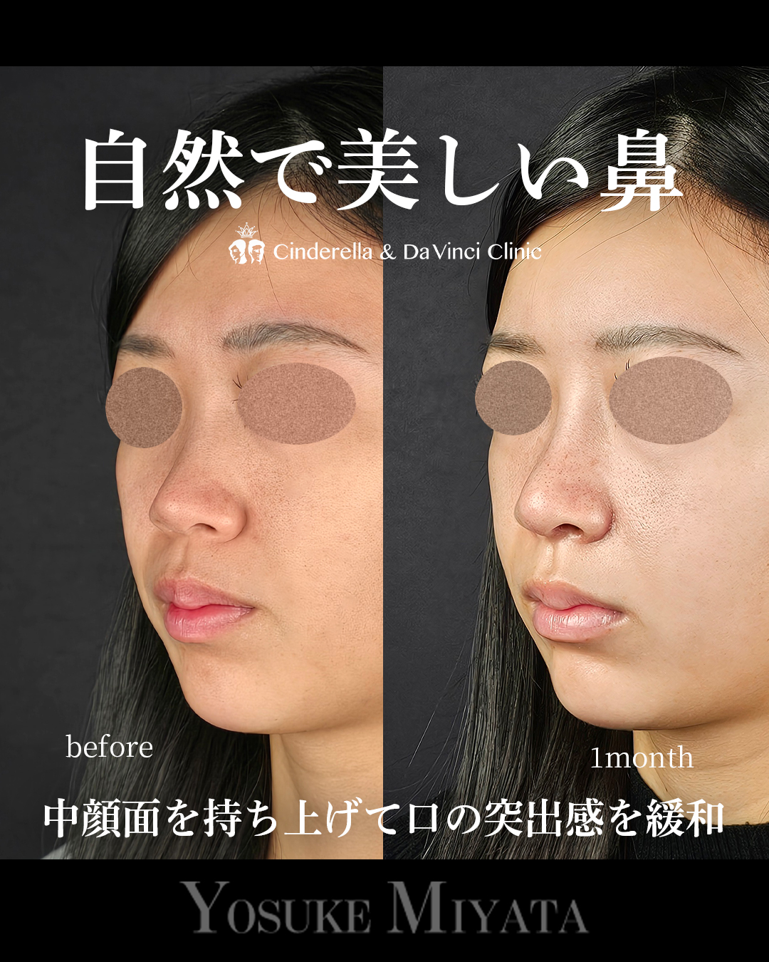 自然で美しい鼻の画像