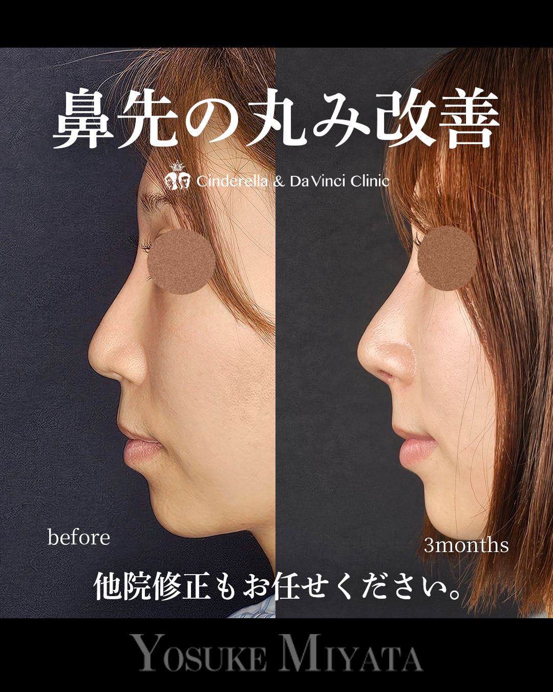 鼻先の丸み改善の画像