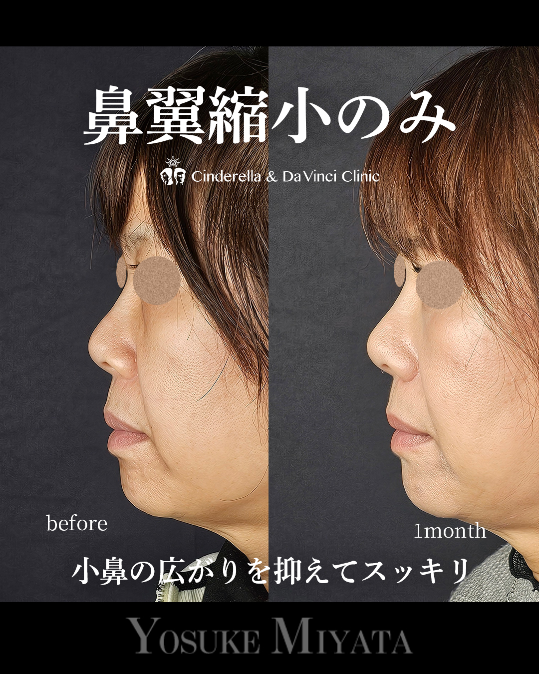 鼻翼縮小のみの画像