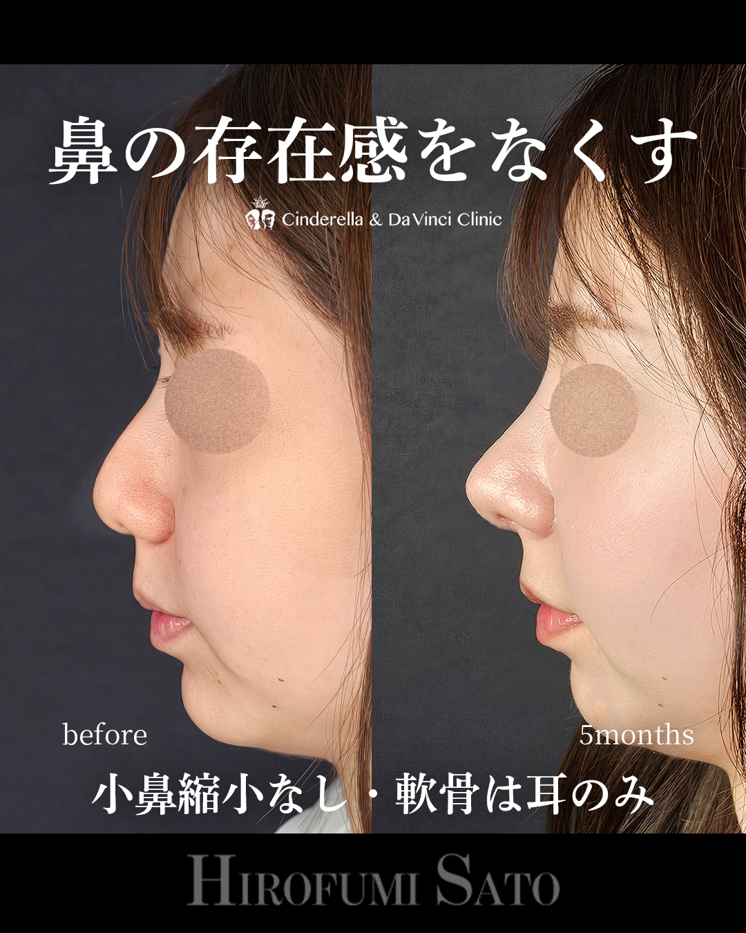 鼻の存在感をなくすの画像