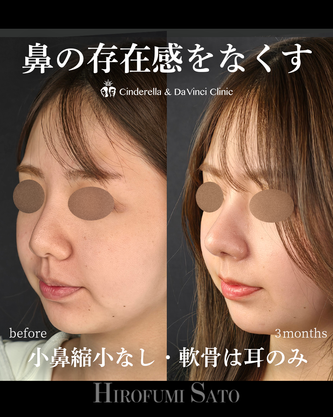 鼻の存在感をなくすの画像