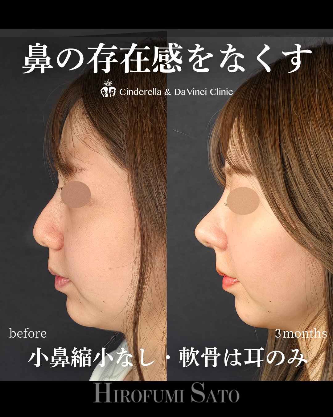 鼻の存在感をなくすの画像