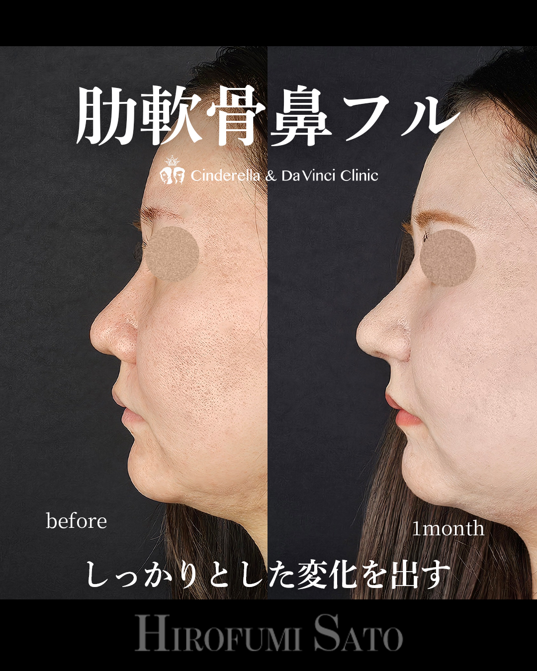 肋軟骨鼻フルの画像