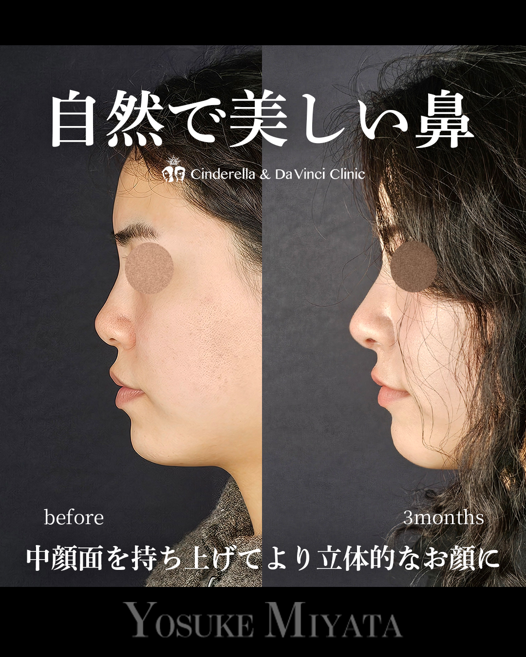 自然で美しい鼻の画像