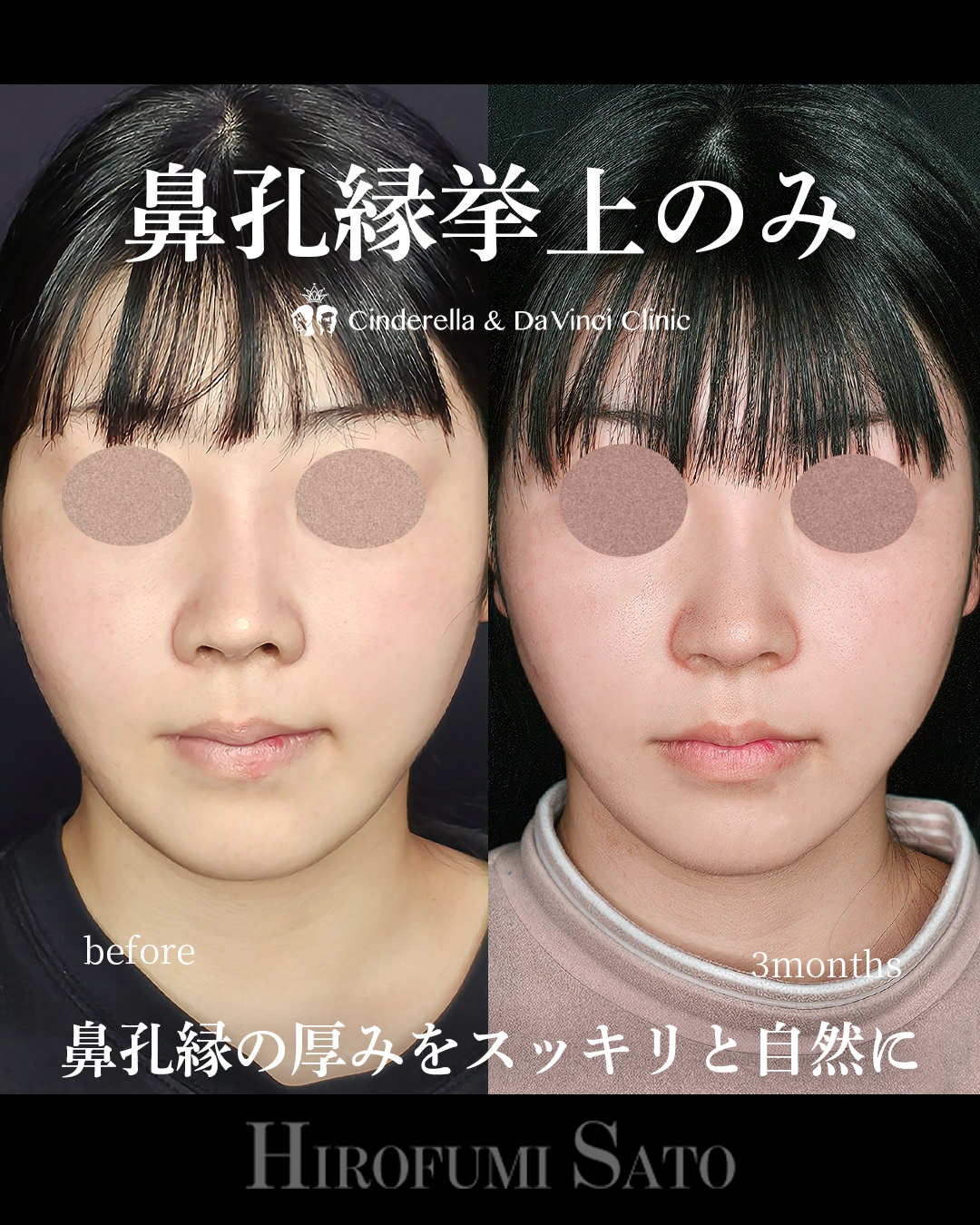 鼻孔縁挙上のみの画像