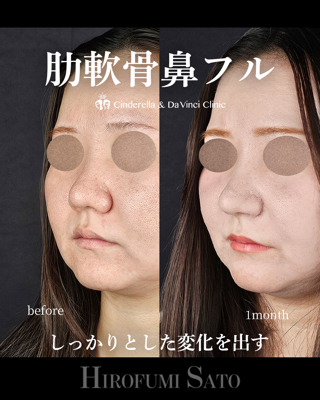 肋軟骨鼻フルの画像