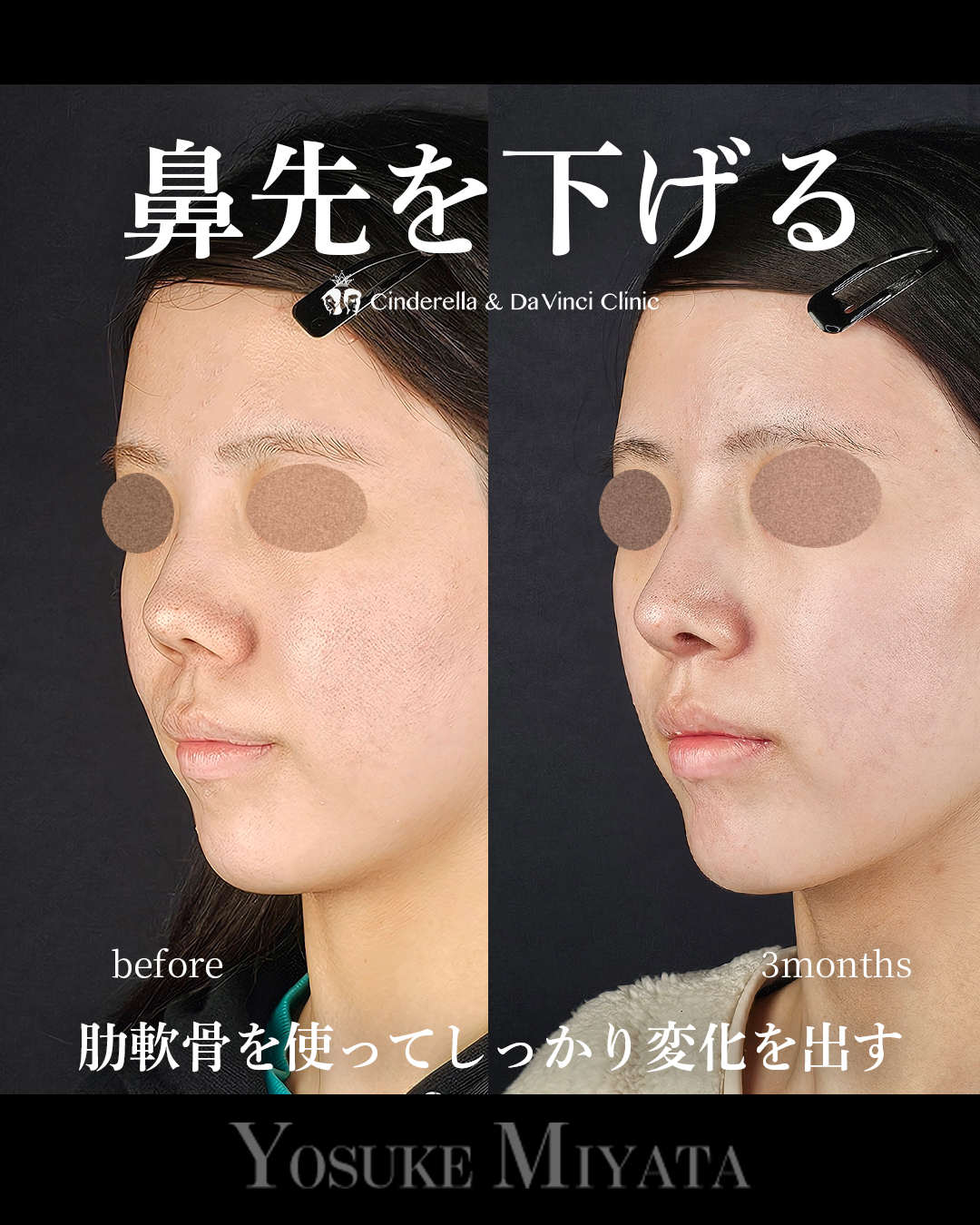 鼻先を下げるの画像