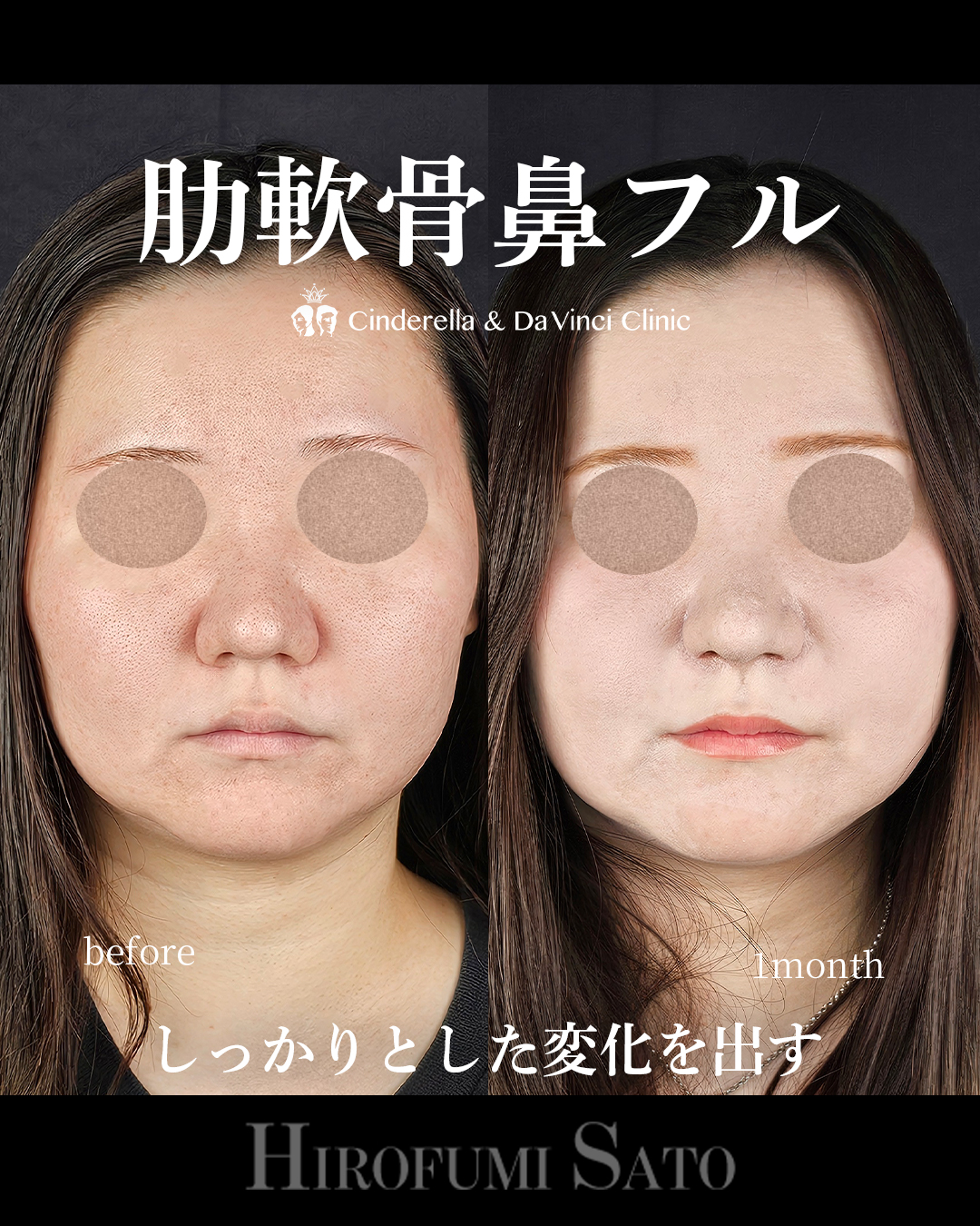 肋軟骨鼻フルの画像