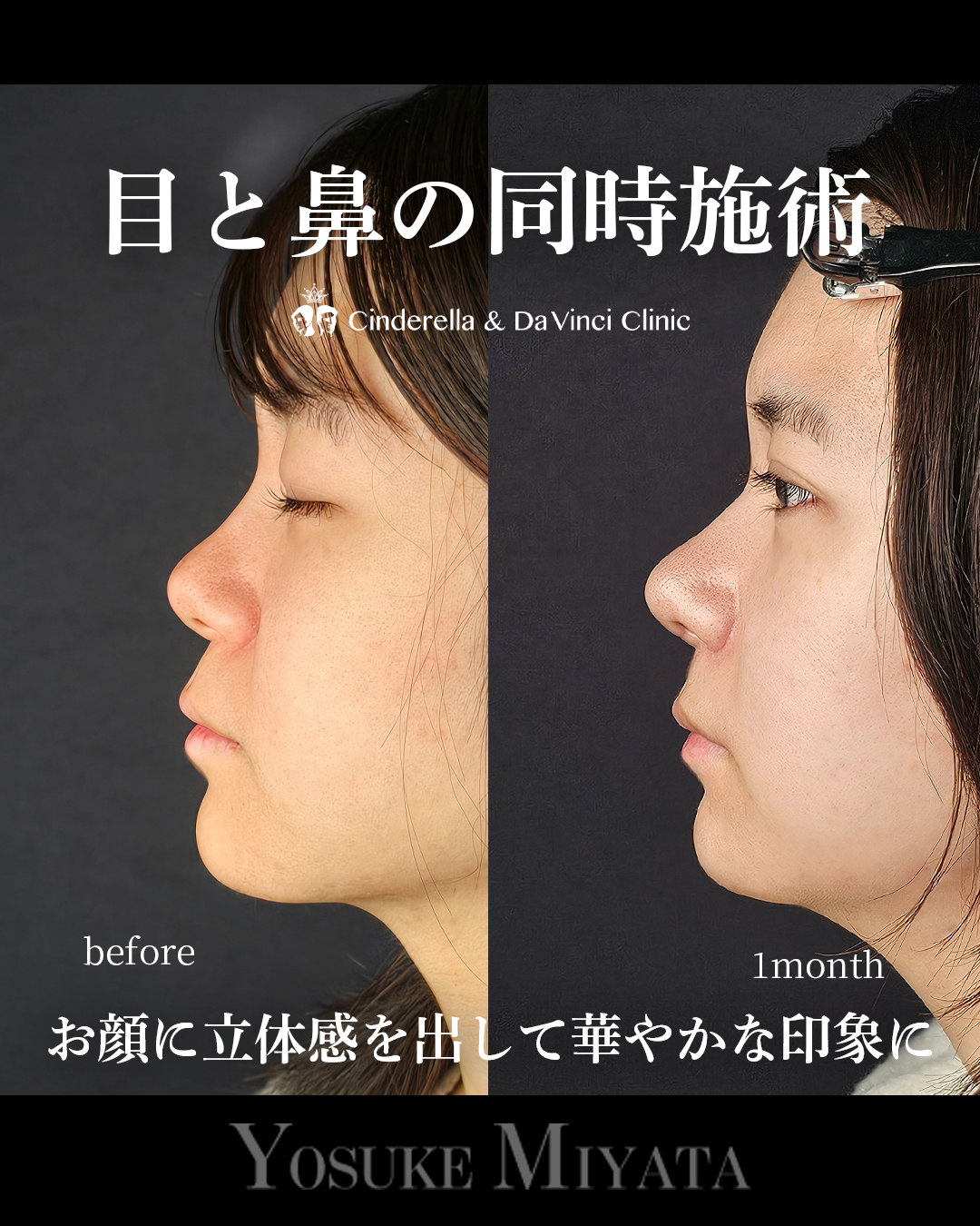 目と鼻の同時施術の画像