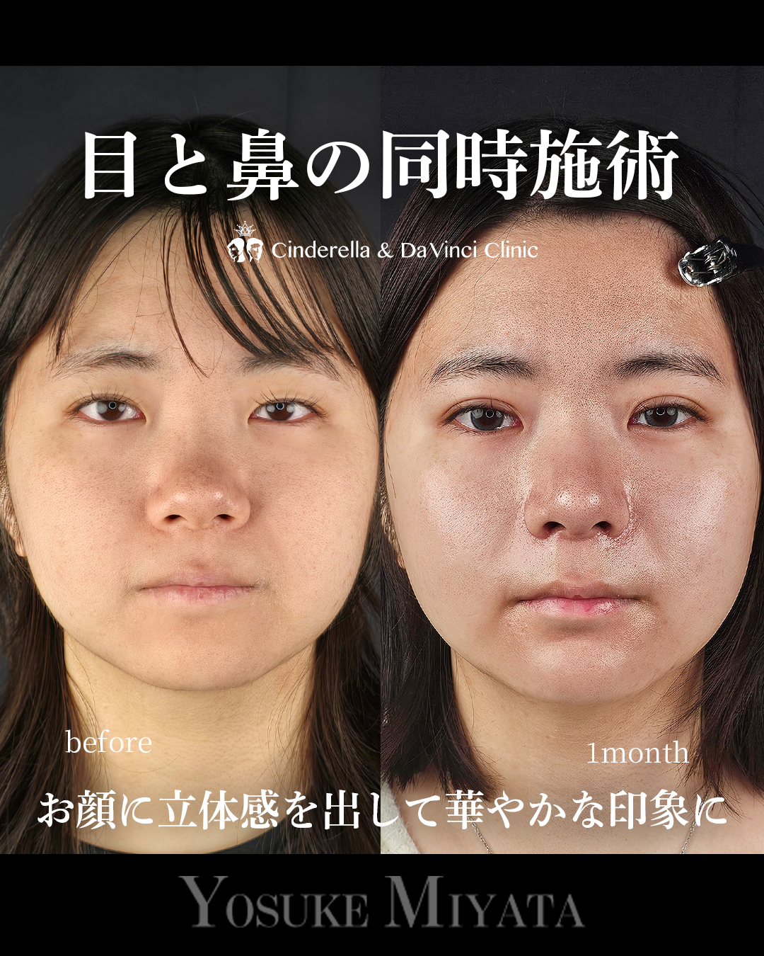 目と鼻の同時施術の画像