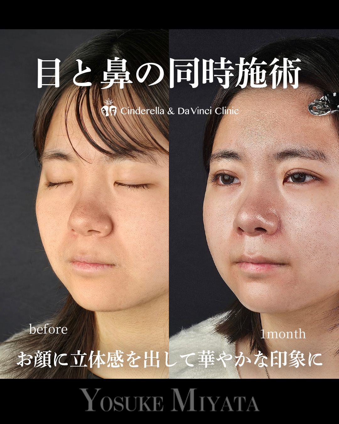 目と鼻の同時施術の画像