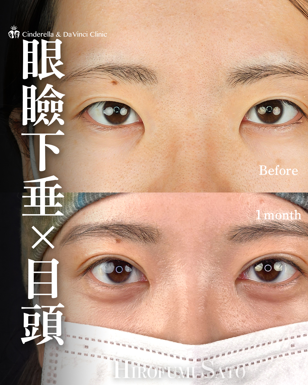 目をぱっちりさせるの画像