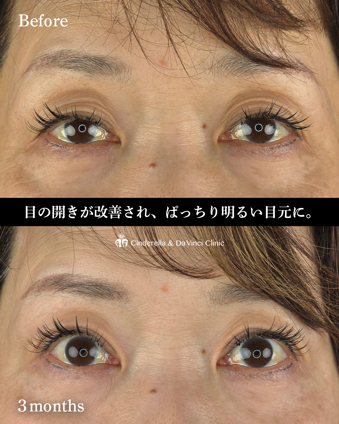 目の開きを改善の画像