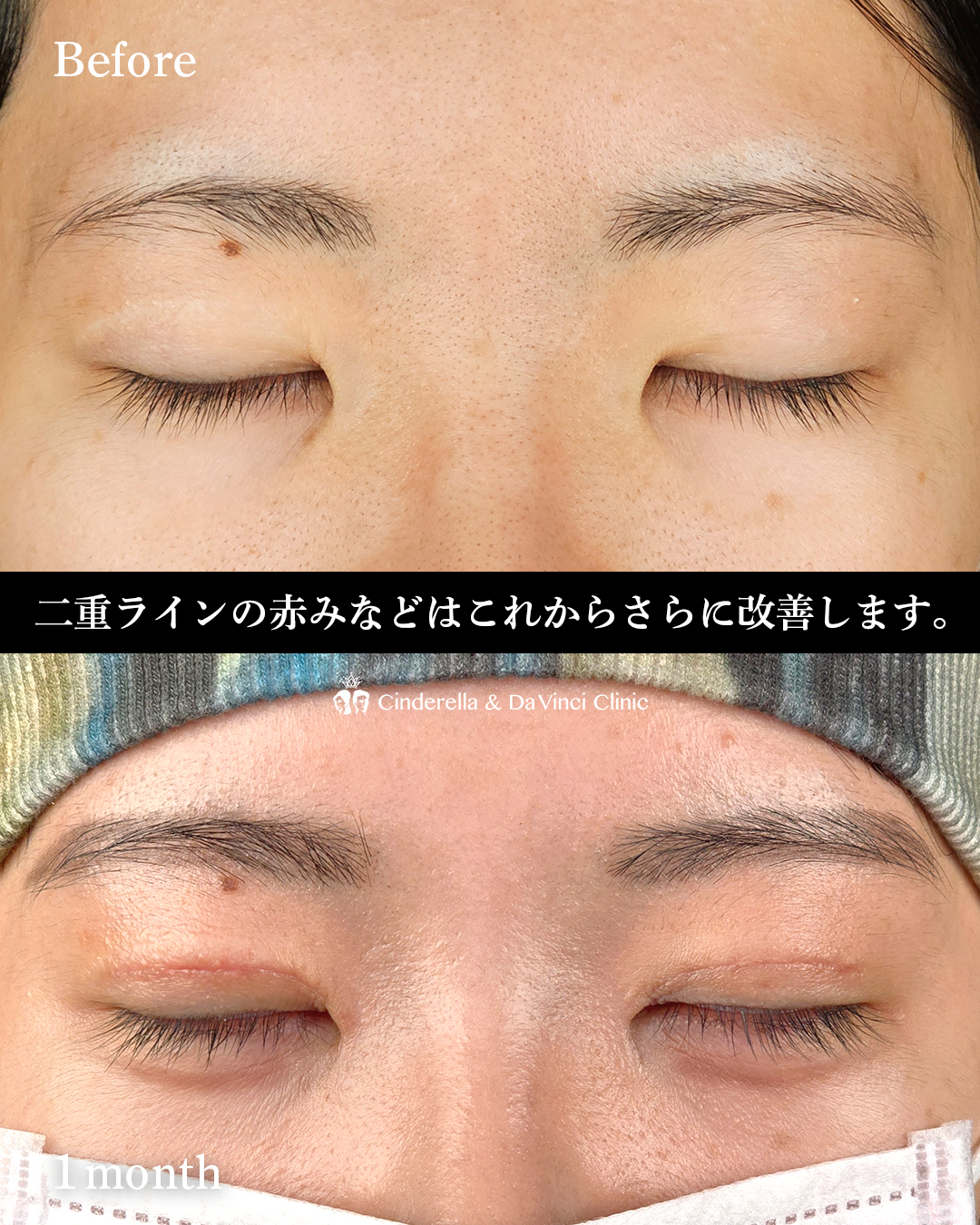 目をぱっちりさせるの画像