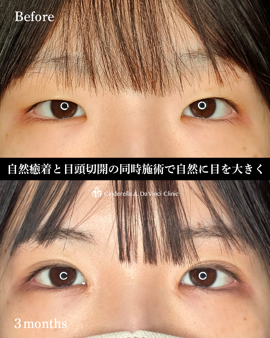 目を大きくするの画像