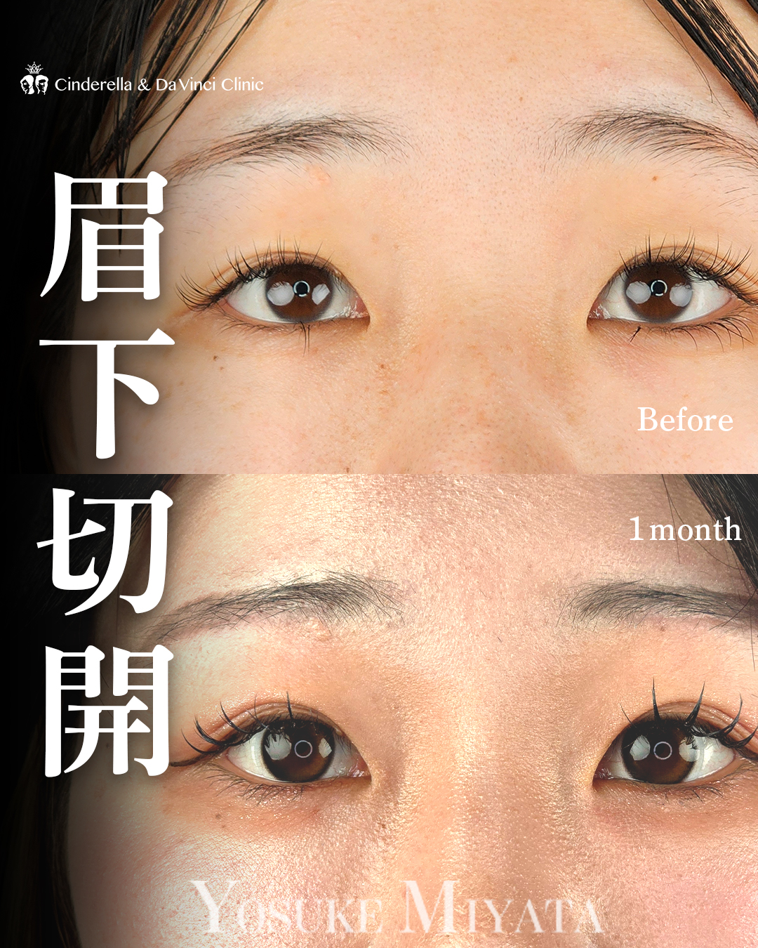 目と眉の距離近づけるの画像