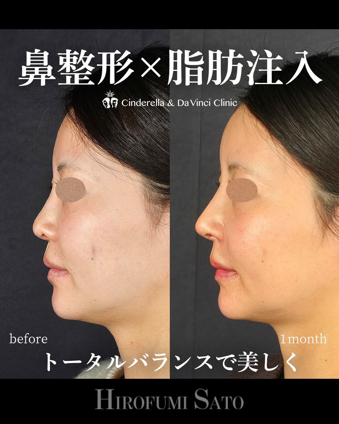 鼻整形と脂肪注入同時の画像