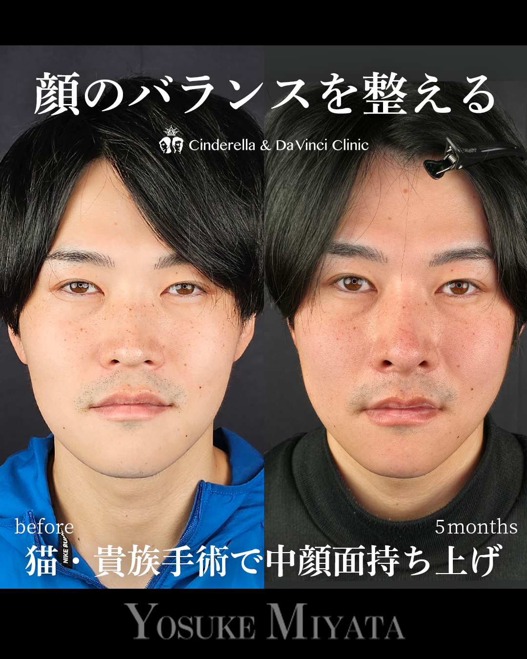 鼻整形で顔のバランスを整えるの画像