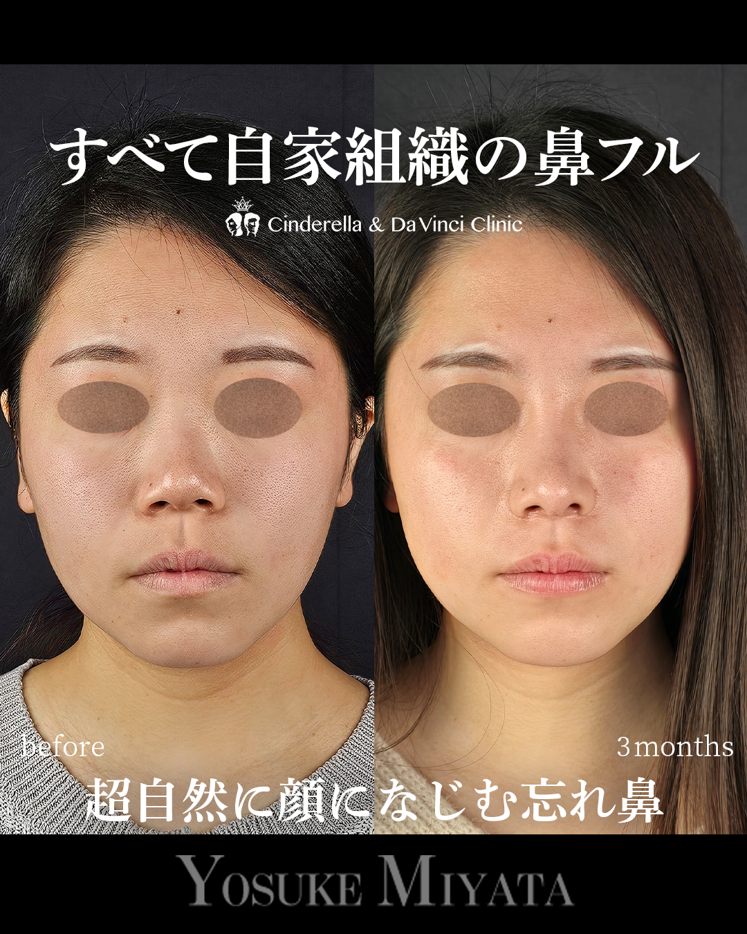 自家組織の鼻フル