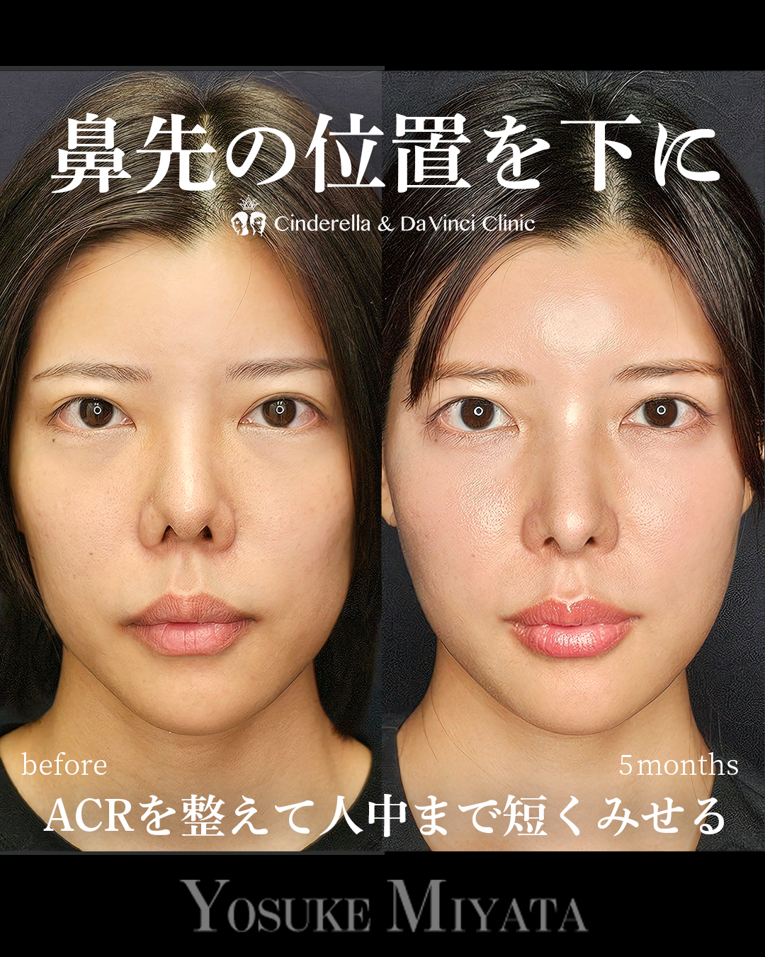 鼻先の位置を下にするの画像