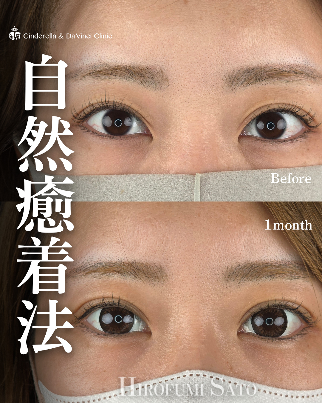 埋没で二重幅を安定させるの画像