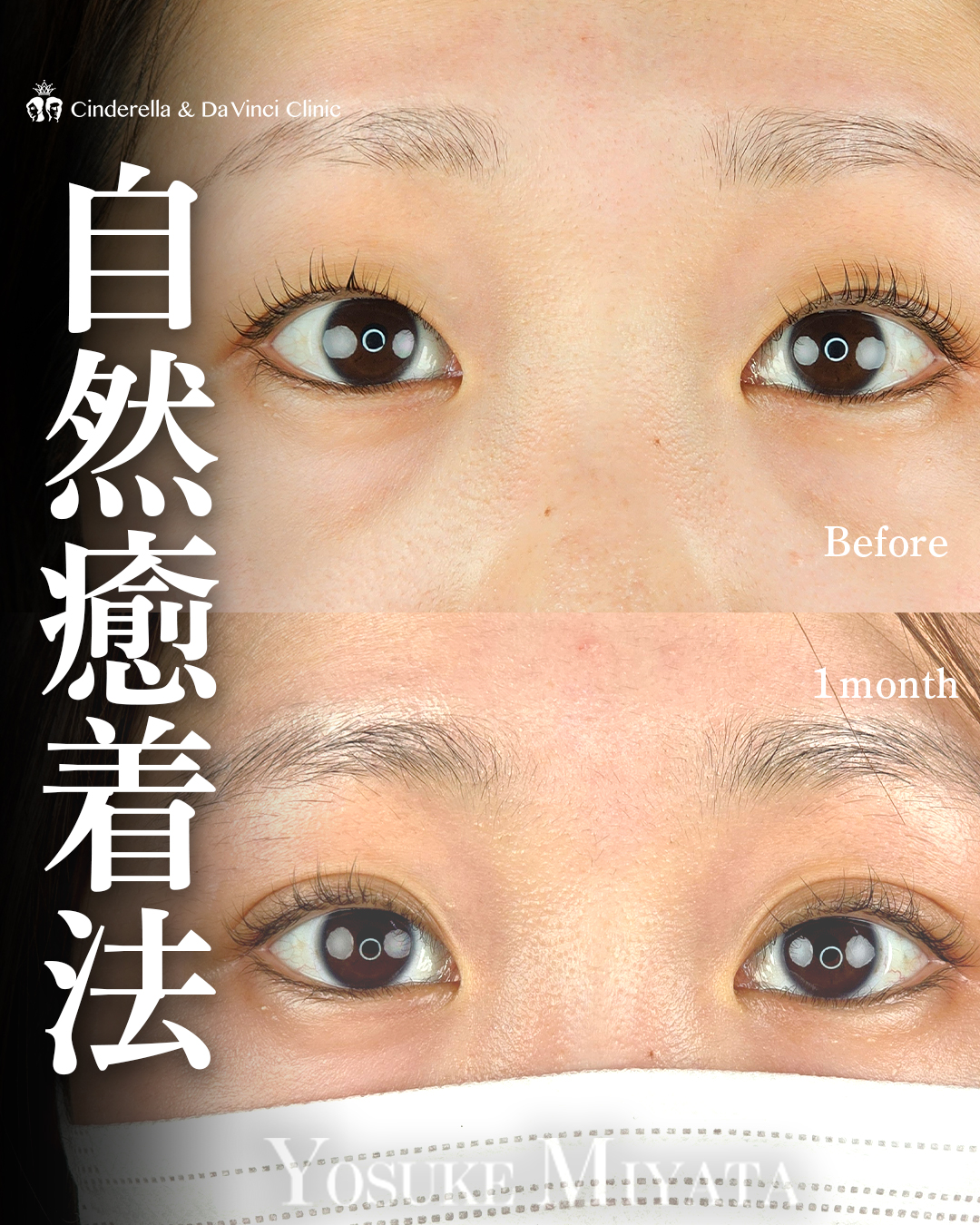 自然な幅広二重