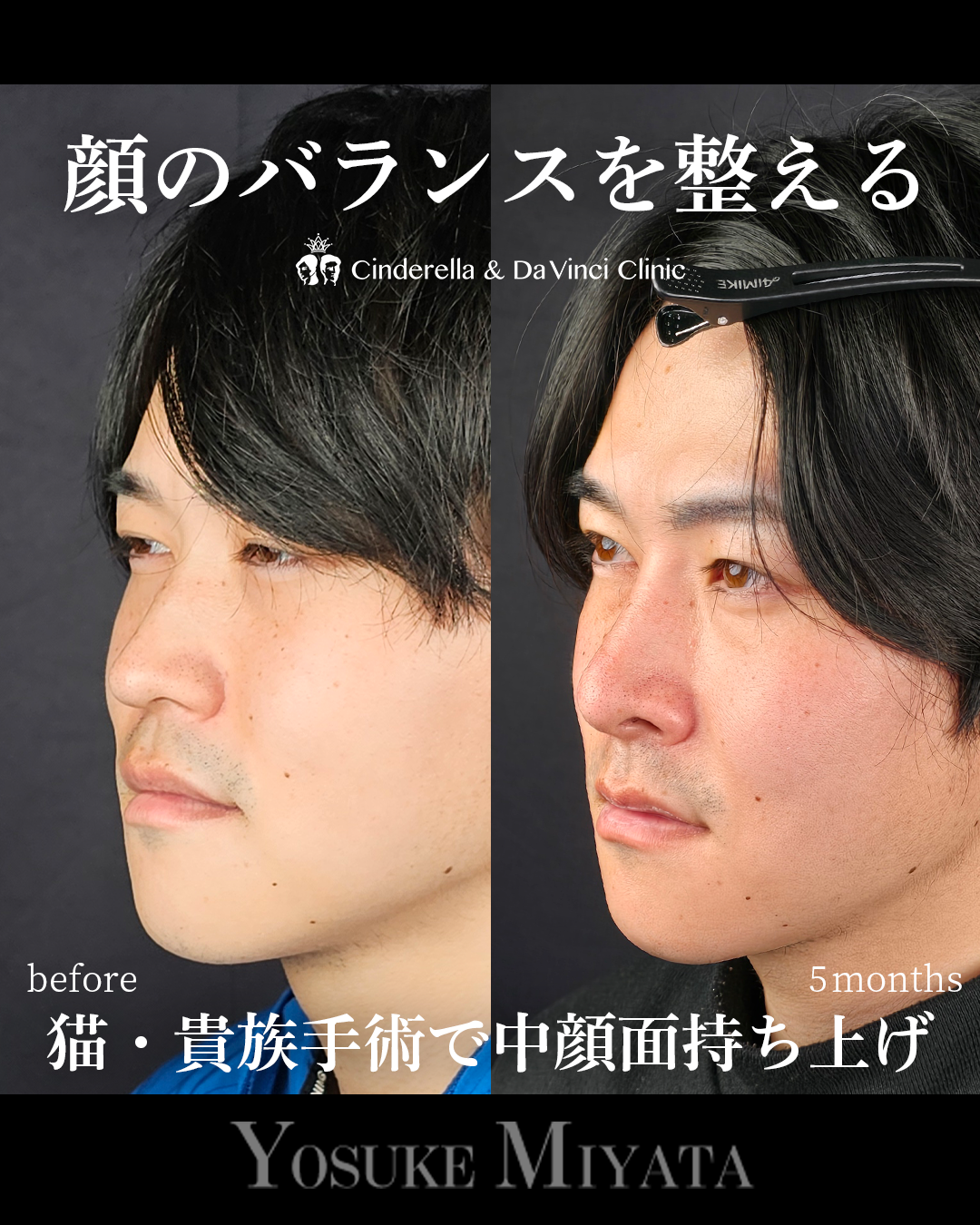 鼻整形で顔のバランスを整えるの画像