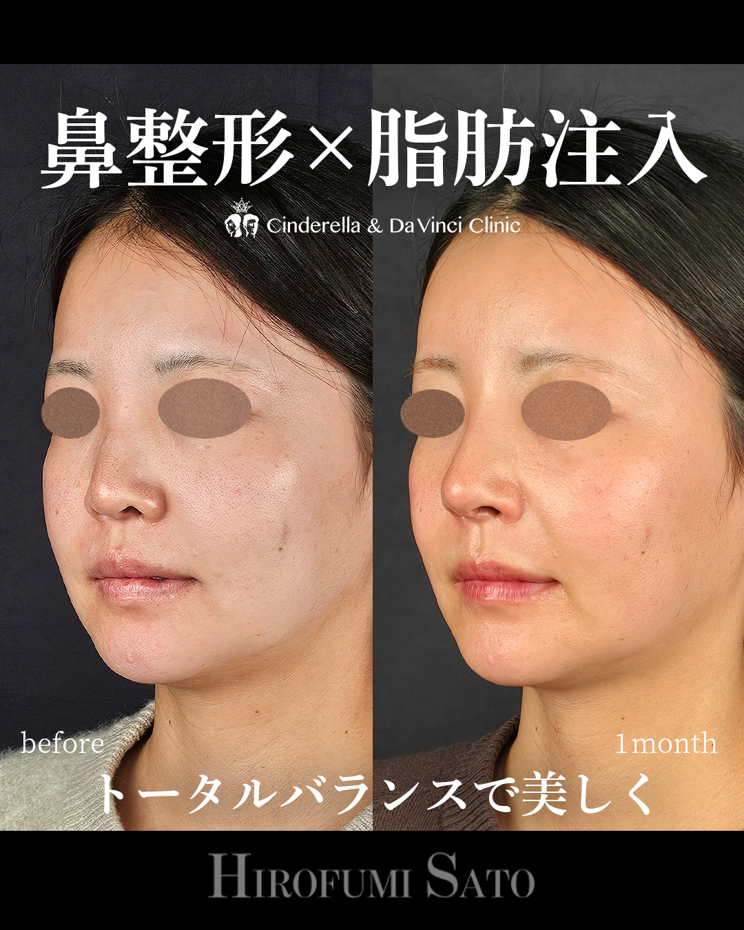 鼻整形と脂肪注入同時の画像