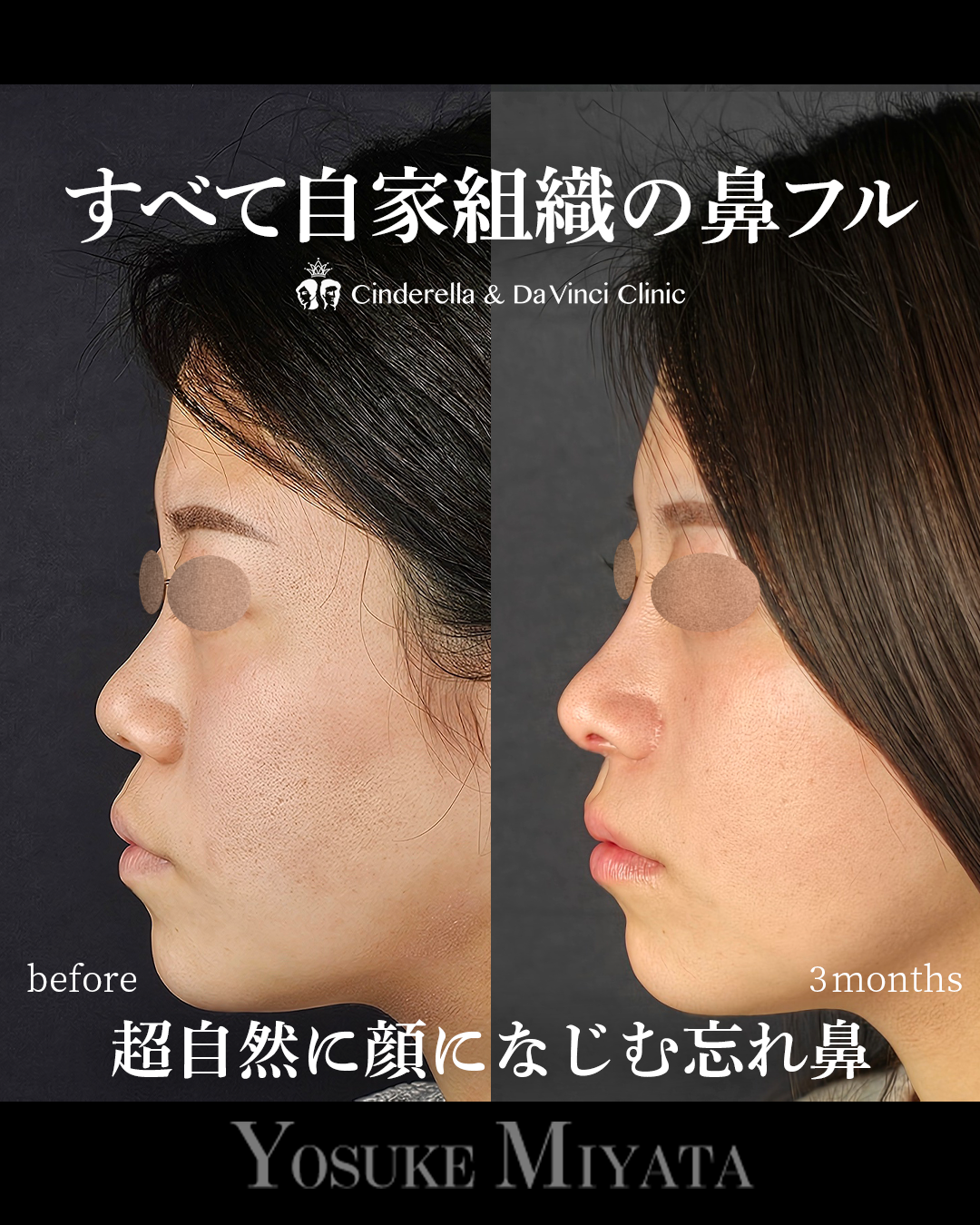 自家組織の鼻フルの画像