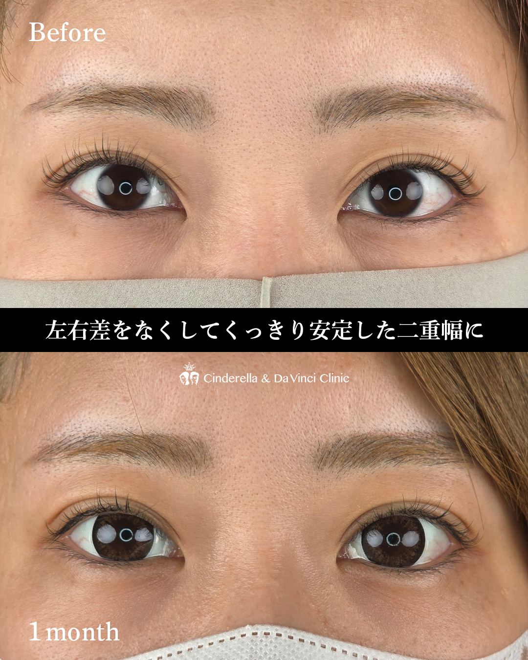 埋没で二重幅を安定させるの画像