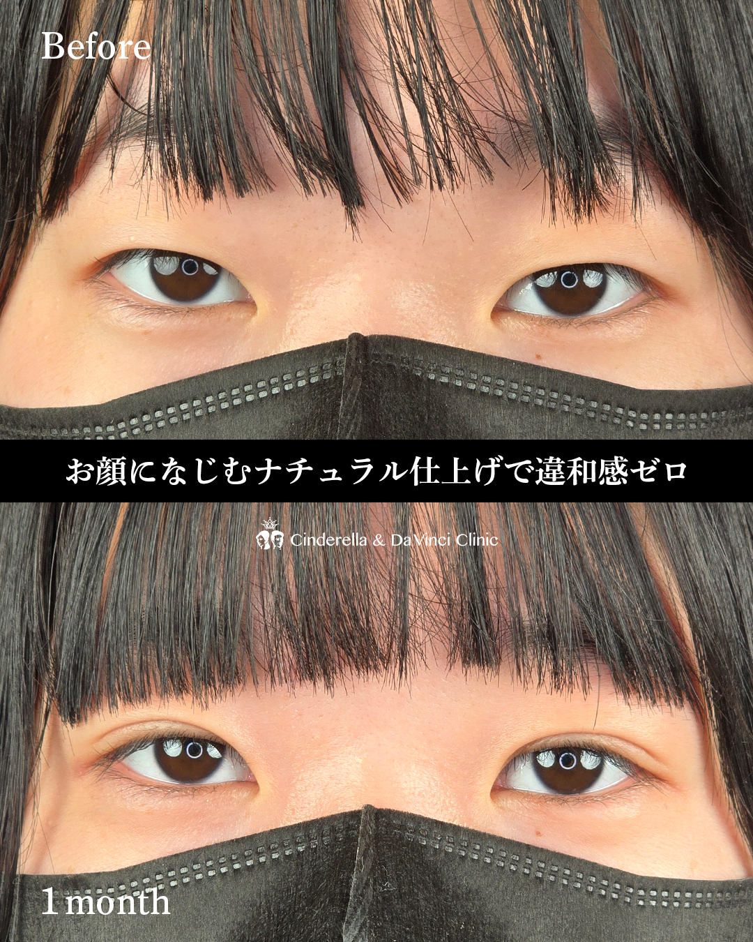 自然癒着の末広二重の画像