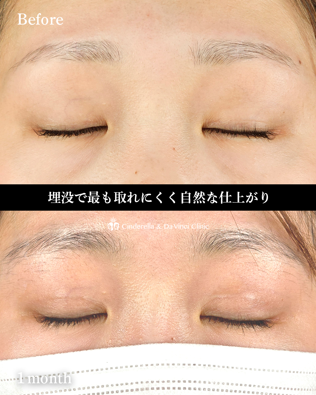 自然な幅広二重の画像