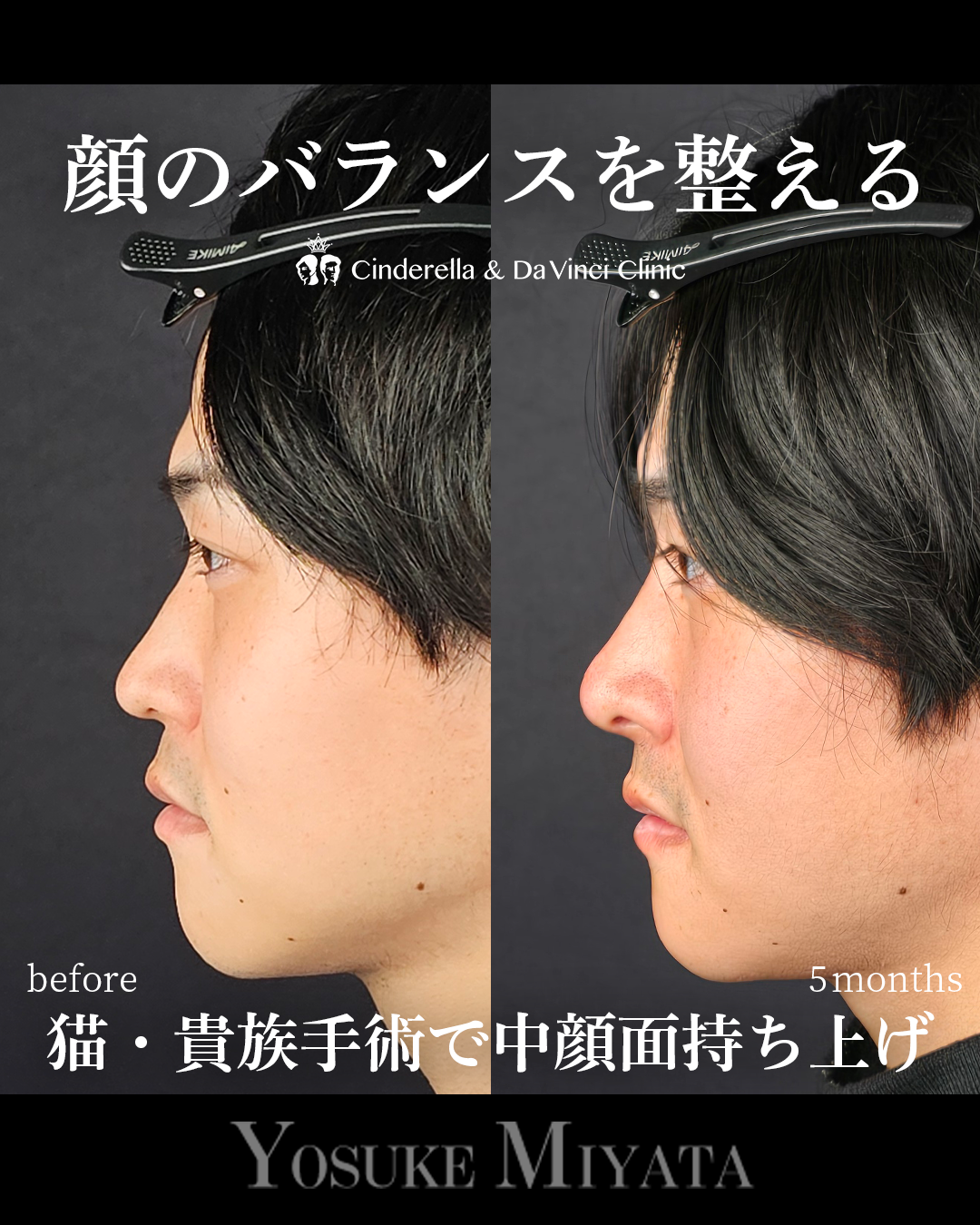 鼻整形で顔のバランスを整えるの画像