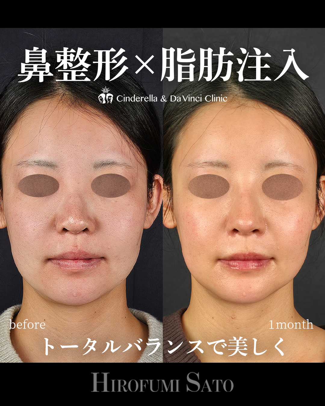 鼻整形と脂肪注入同時の画像