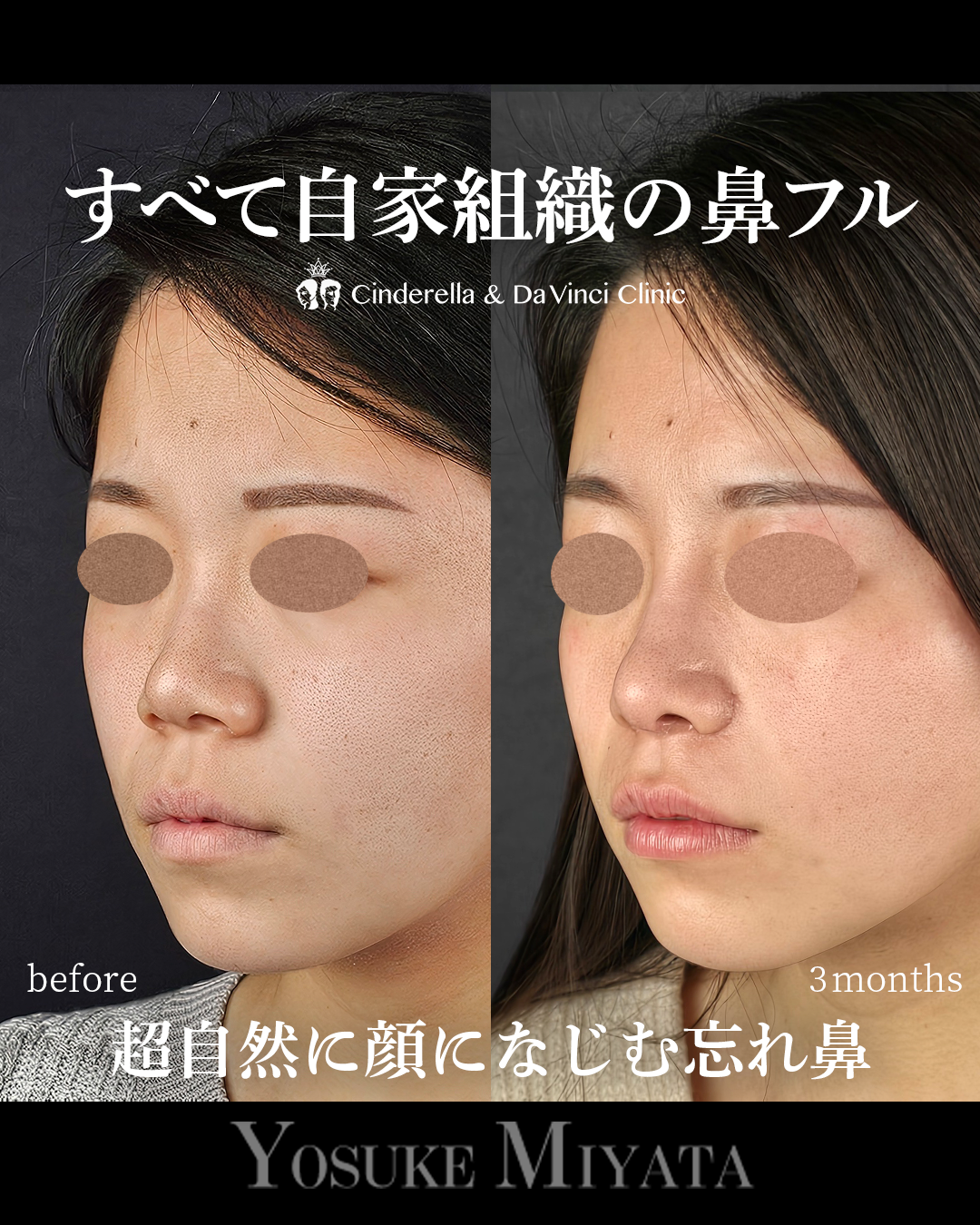 自家組織の鼻フルの画像