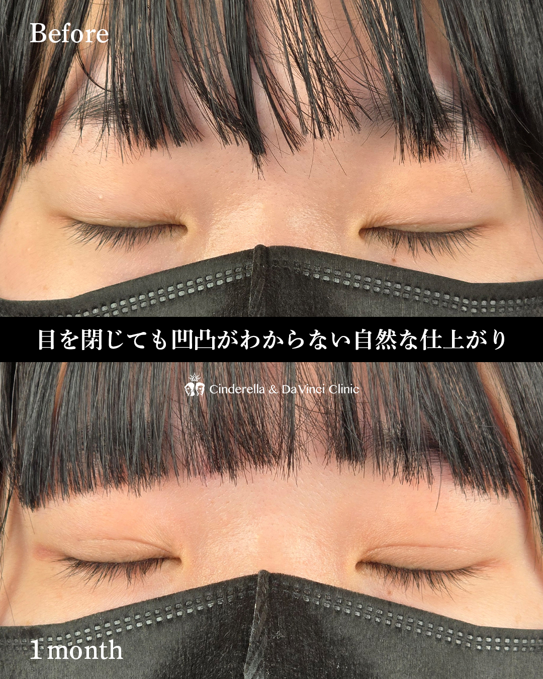 自然癒着の末広二重の画像