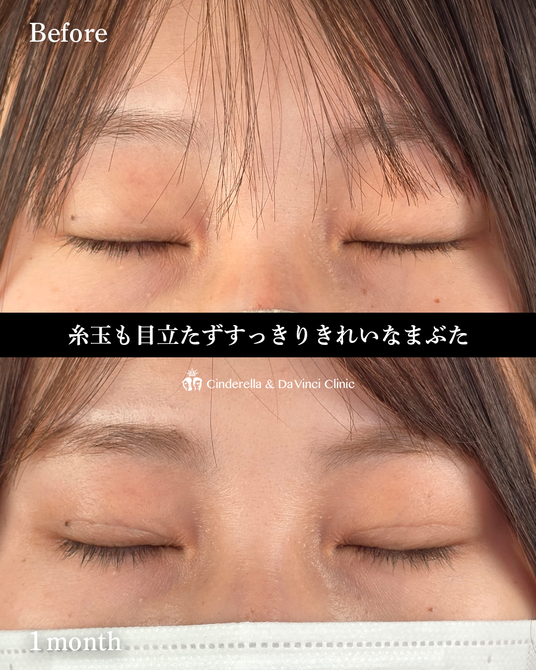 自然癒着法でぱっちりの画像