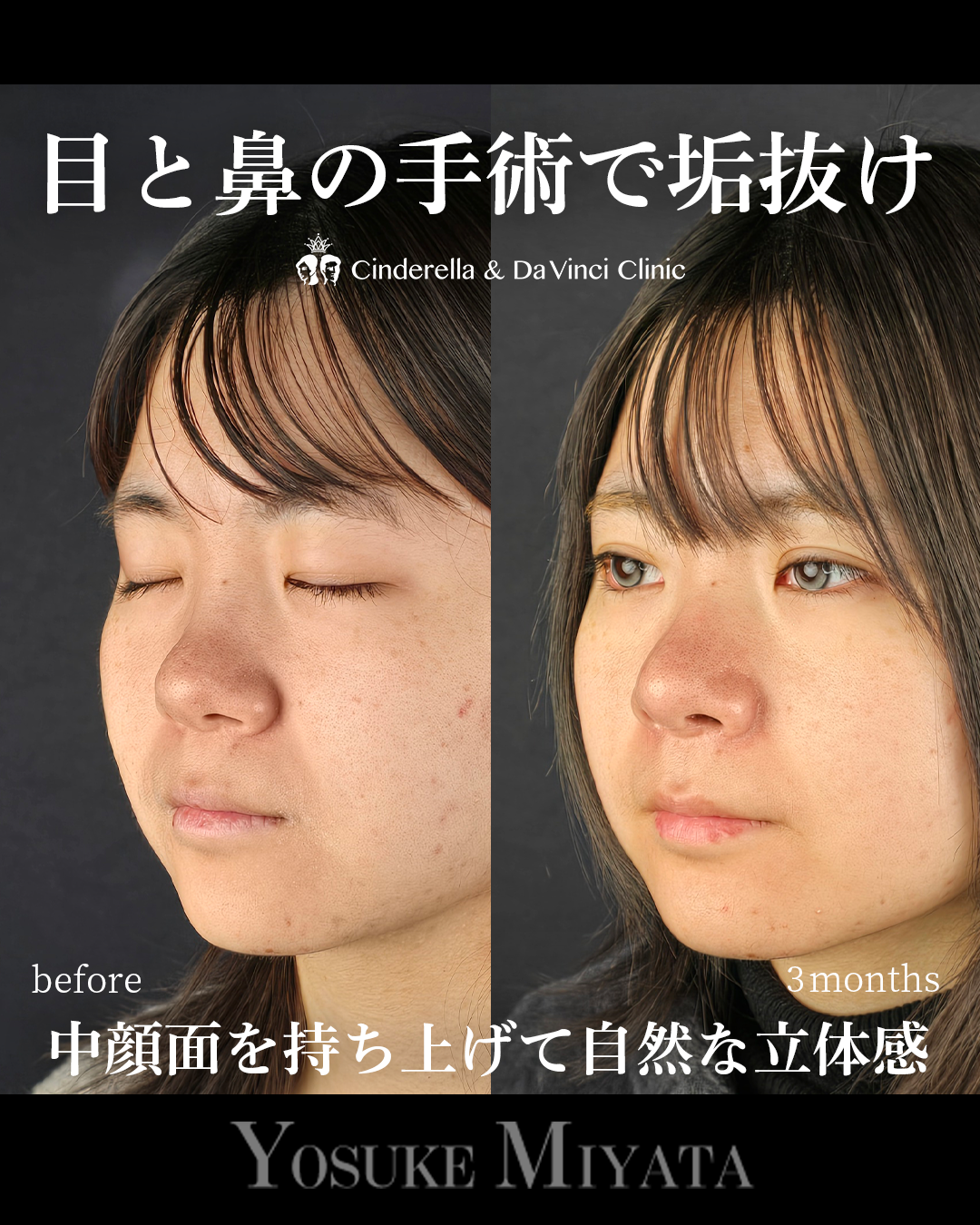 目と鼻の同時施術の画像